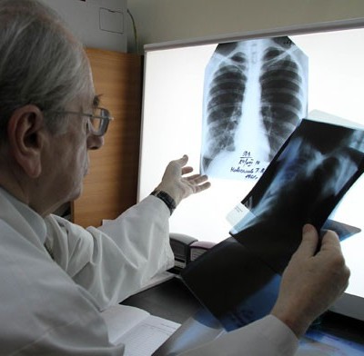 Туберкулез и его лечение